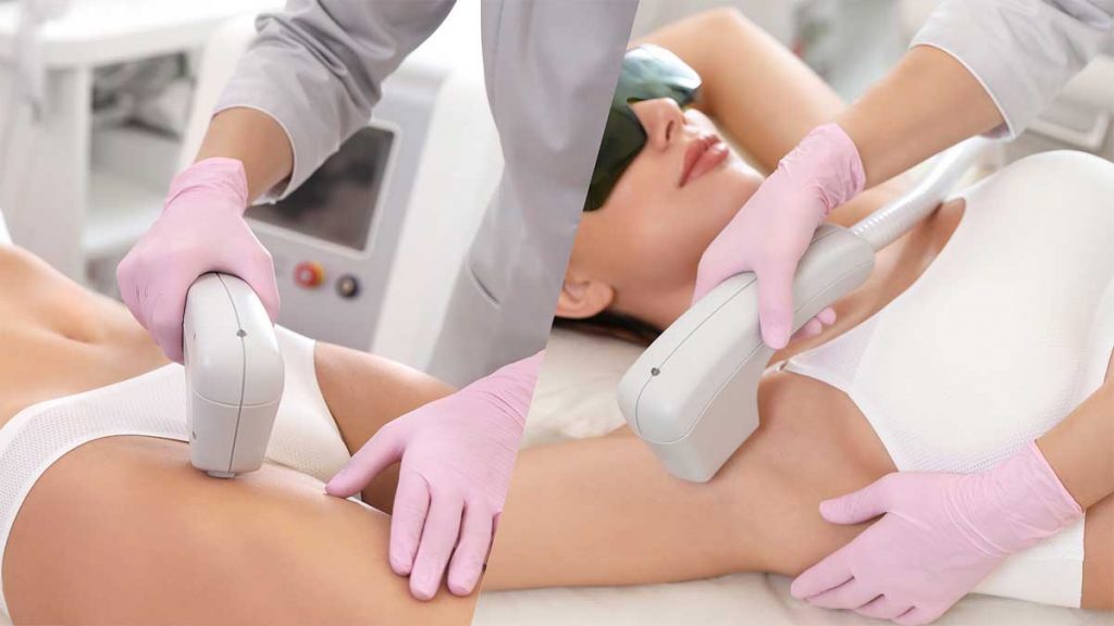 Depilación laser en Mérida